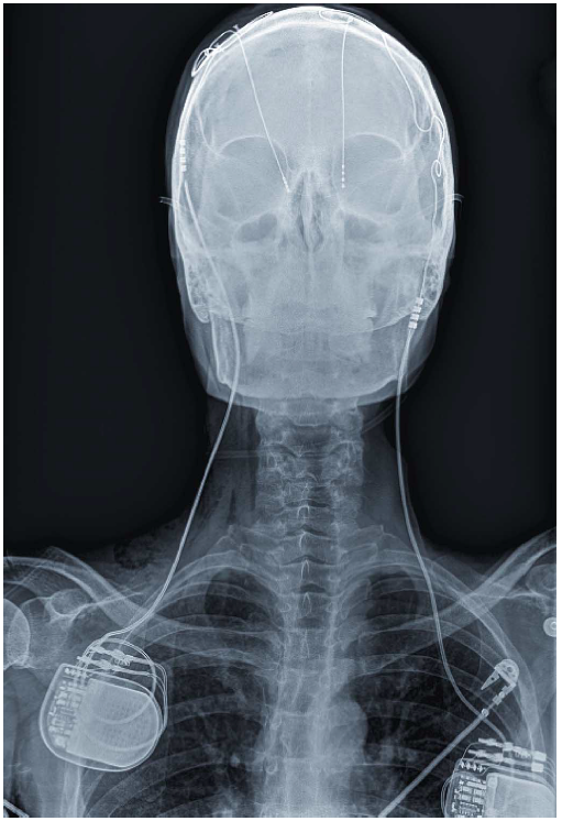 X-ray of DBS patient